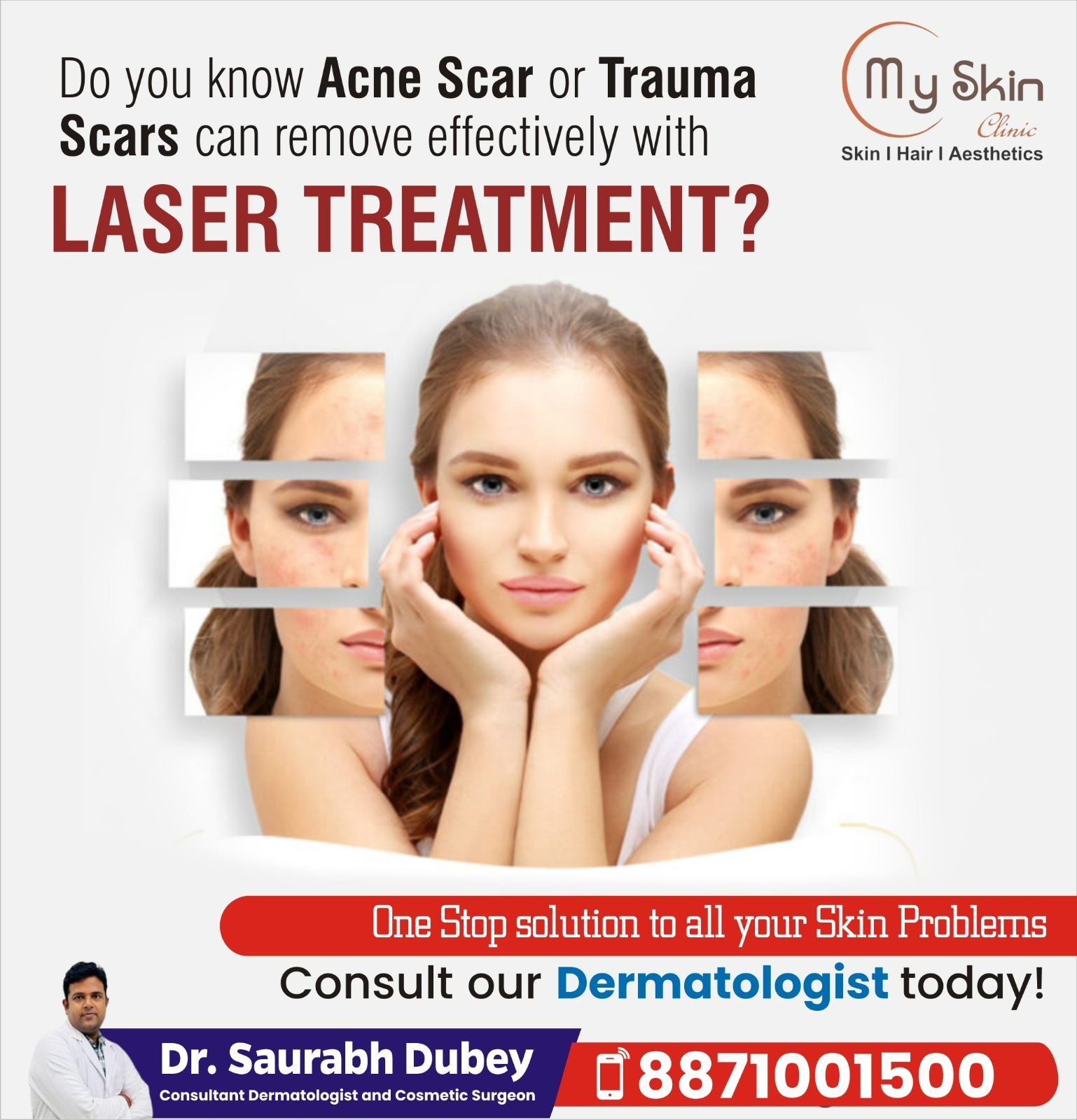 Acne Scar Laser Treatment in Indore